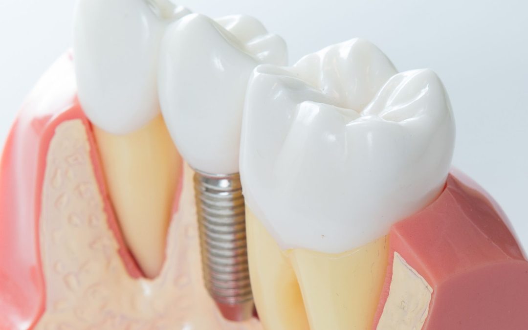 Impiantologia Computer Guidata