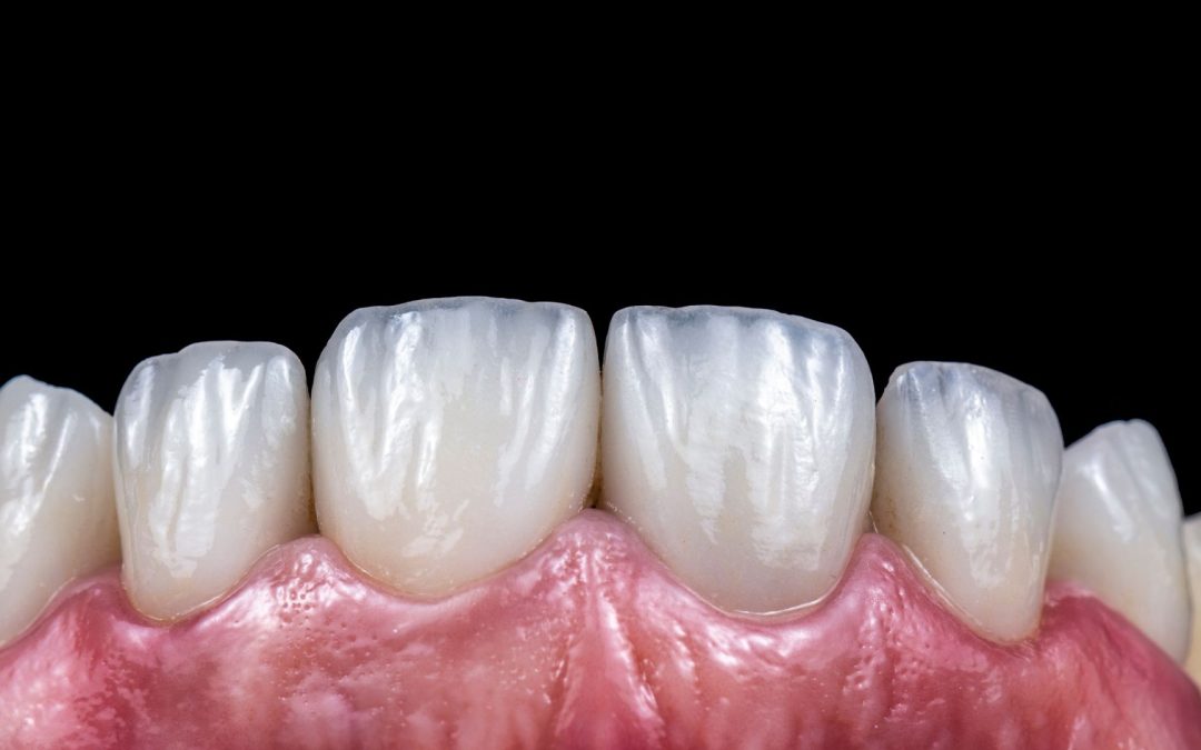 Faccette In Ceramica